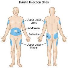 Insulin Injection Sites Insulin Injection Sites