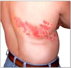 shingles symptoms causes and treatments