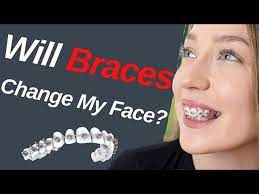 will braces change my face dentist