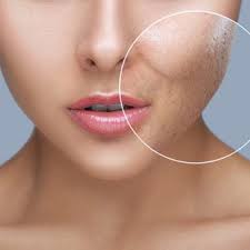 acne scar removal tips