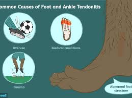 For examples and a much more thorough explanation, take a look at the two wikipedia pages Treatment For Tendonitis Of The Foot And Ankle