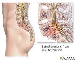 spinal stenosis information mount