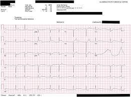 There is a diagonal artery that is a branch of the left coronary artery on the surface of the heart. Acute First Diagonal Artery Occlusion A Characteristic Pattern Of St Elevation In Noncontiguous Leads The American Journal Of Emergency Medicine