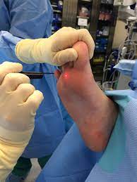 laser surgery alpine foot specialists