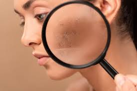 how to get rid of acne scars summitmd
