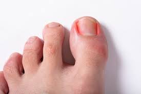 why do you get ingrown toenails