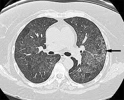 Review Of The Chest Ct Diffeial