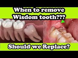 wisdom teeth pain teeth pain relief
