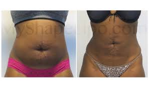 is liposuction really permanent myshape lipo patient interviewed one year after her abdominal lipo with brazilian lift