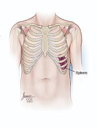 Could chondritis cause flares of aching pain under and around bottom of rib cage, front and back, that worsens with activity and improves lying down? answered by dr. Enlarged Spleen Splenomegaly