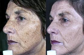 cosmetic dermatology laser for brown