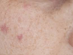 squamous cell carcinoma skin cancer