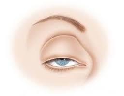 droopy eyelid how to fix droopy
