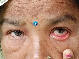 eye infections during monsoon season