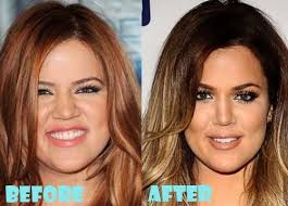 Khloe kardashian before and after plastic surgery. Khloe Kardashian Nose Job Khloe Kardashian Plastic Surgery Kardashian Plastic Surgery Plastic Surgery