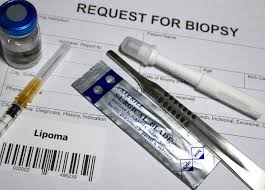 excisional biopsy tests treatments
