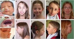 candidate gene for cleft palate