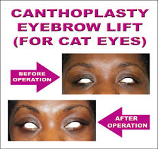 Thecost of eyelid surgery or blepharoplasty depends on several factors.these factors include: Eyebrow Shaping Eyebrow Lift Canthoplasty Canthral Tilt