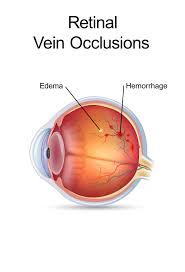 retinal vein occlusion iran health