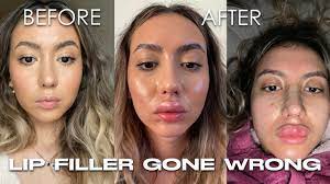 my lip filler horror story juvederm