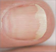 nail disorders and systemic disease