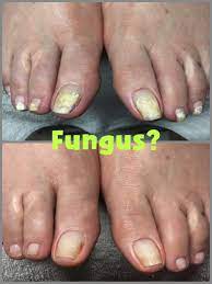 remove white spots on the toenails
