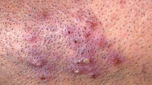 ingrown hair cyst symptoms treatment