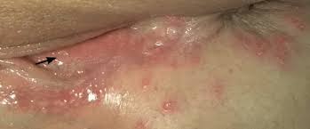 herpes clinical feature