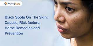 black spots on the skin causes risk