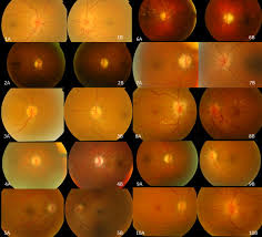 This form of ischemic optic neuropathy is generally categorized as two types: Sequential Non Arteritic Anterior Ischemic Optic Neuropathy In Patients Taking Sildenafil A Report Of Ten Cases Sciencedirect