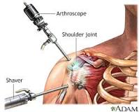Image result for icd 10 code for arthroscopic right shoulder surgery