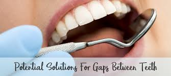 When the gap in front teeth is due to a missing tooth, a bridge or an implant is a great way to close this gap. Simple Solutions For Gaps Between Teeth Northstar Dental