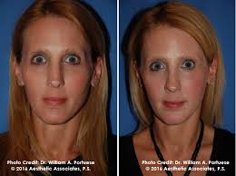 We did not find results for: Wide Nasal Bones Before And After Photo Gallery Nose Surgery Photos