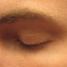 Experts explain how to get rid of those stubborn here, see everything you need to know about milia, from how and why they form, to the safest ways unlike skin on the rest of the face, the eye area does not contain oil glands that can help keep this. Milium Dermatology Wikipedia