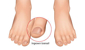 ingrown toenail treatment in frisco