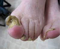 toe nail fungus chemical debridement
