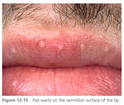 warts herpes simplex and other viral