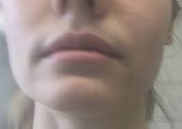 gray upper lip shadow