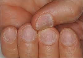 nail dystrophy dermatology conditions