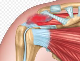 shoulder bursitis a common cause of