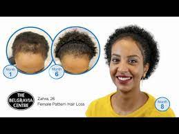 belgravia female hair loss treatment