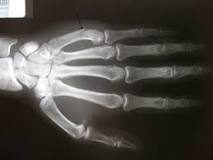 Image result for icd 10 code for boxer's fracture 5th metacarpal