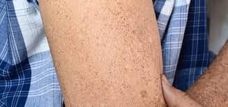 brown spots dermatology and skin