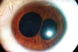 6 interesting unusual eye conditions