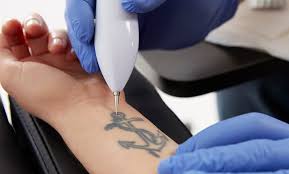 saline tattoo removal vs laser tattoo