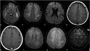 brain abnormalities in some covid 19