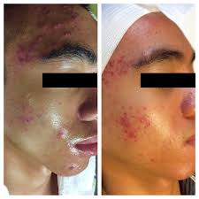 acne scar treatments halo
