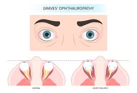 thyroid eye disease ted treatment in