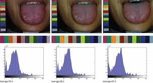 Breast Cancer Index A Perspective On Tongue Diagnosis In