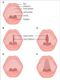 subclinical forms of cleft palate